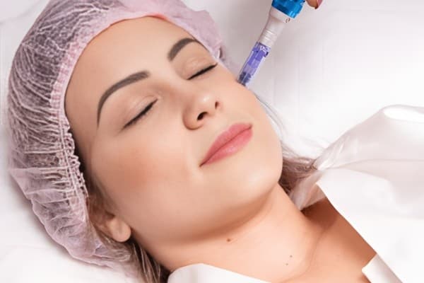 Microdermabrasion treatments
